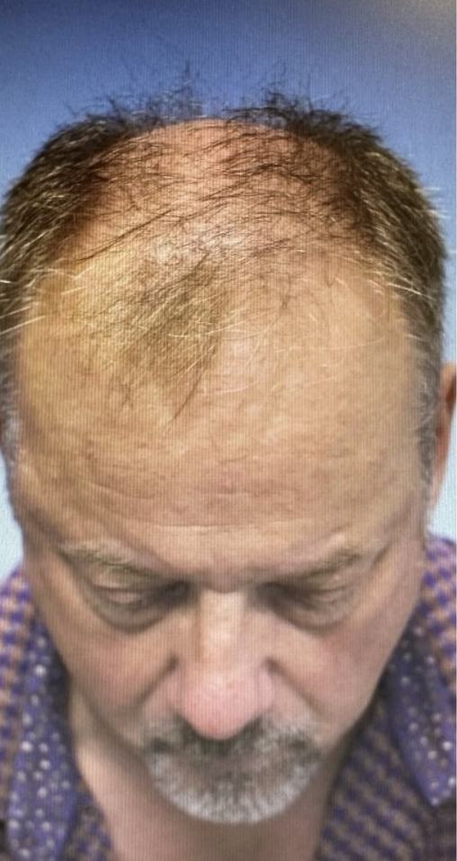 Hair Restoration Before - Front View