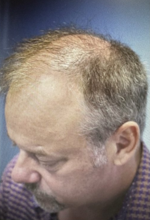 Hair Restoration Before - Left Side View