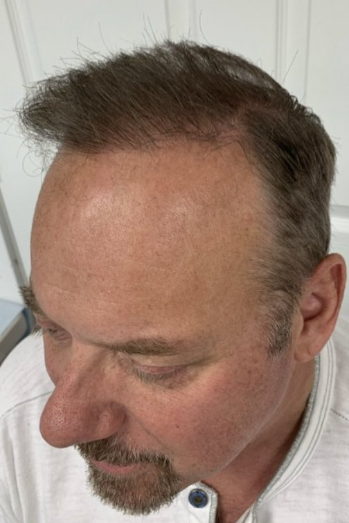 Hair Restoration After - Left Side View