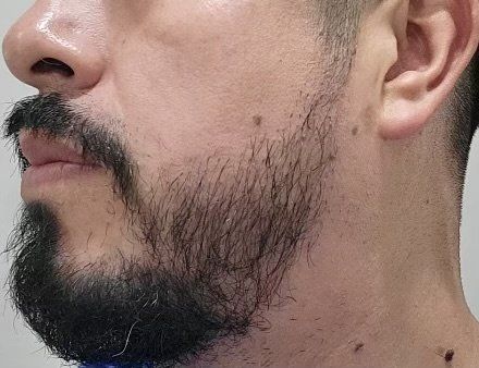 beard growth after