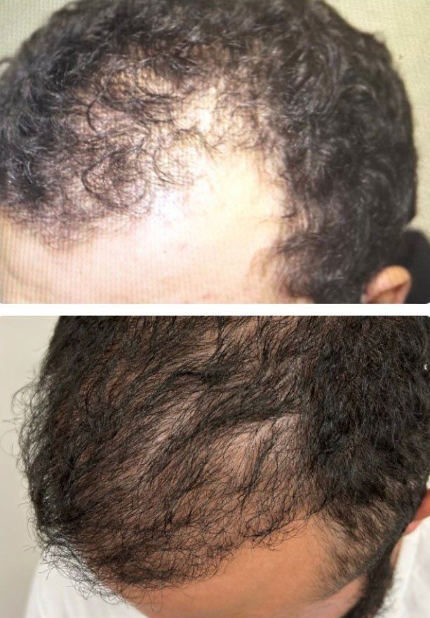 Regency Hair Restoration- Hair Transplant