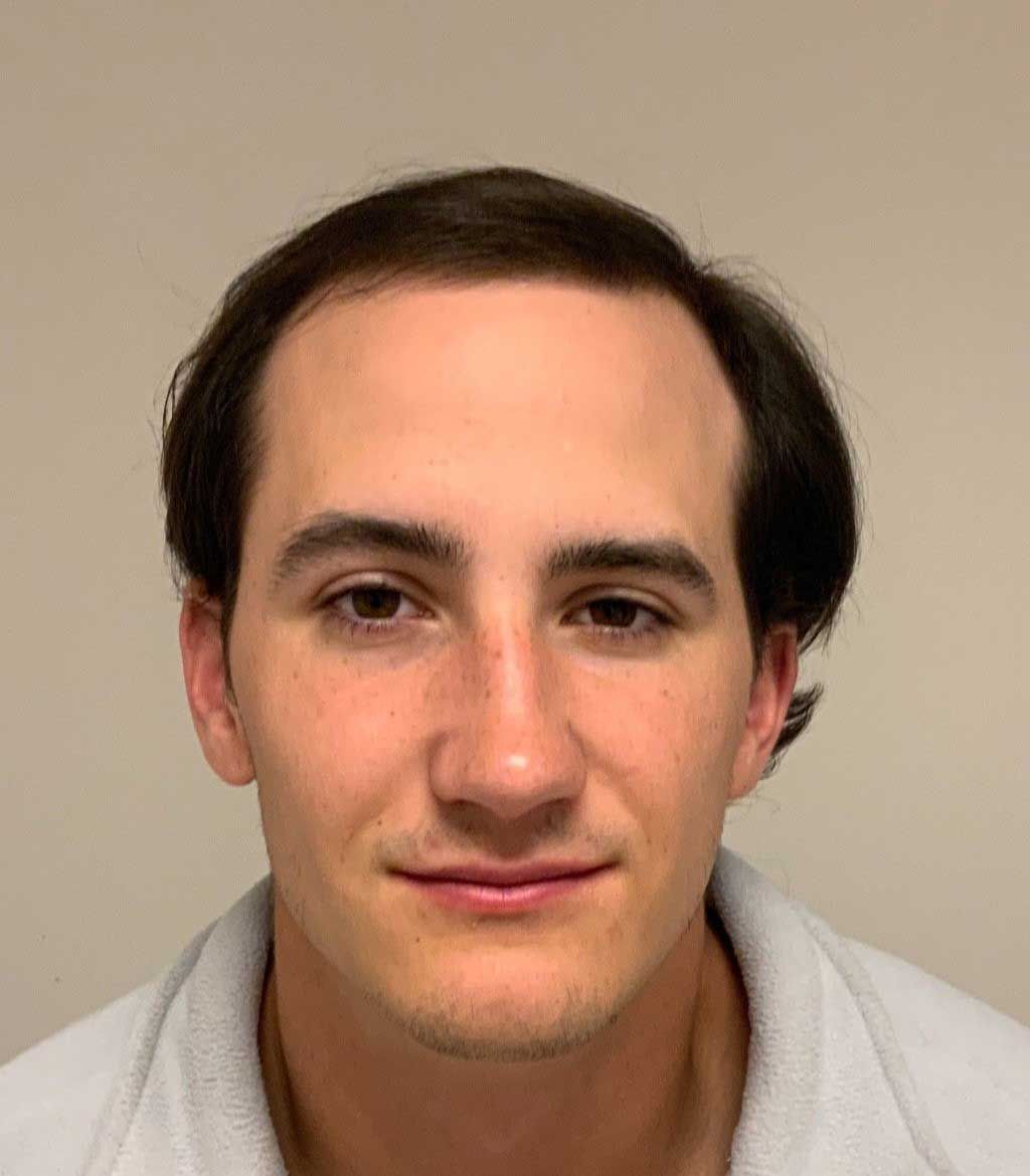 Frontal view of hair restoration - before.