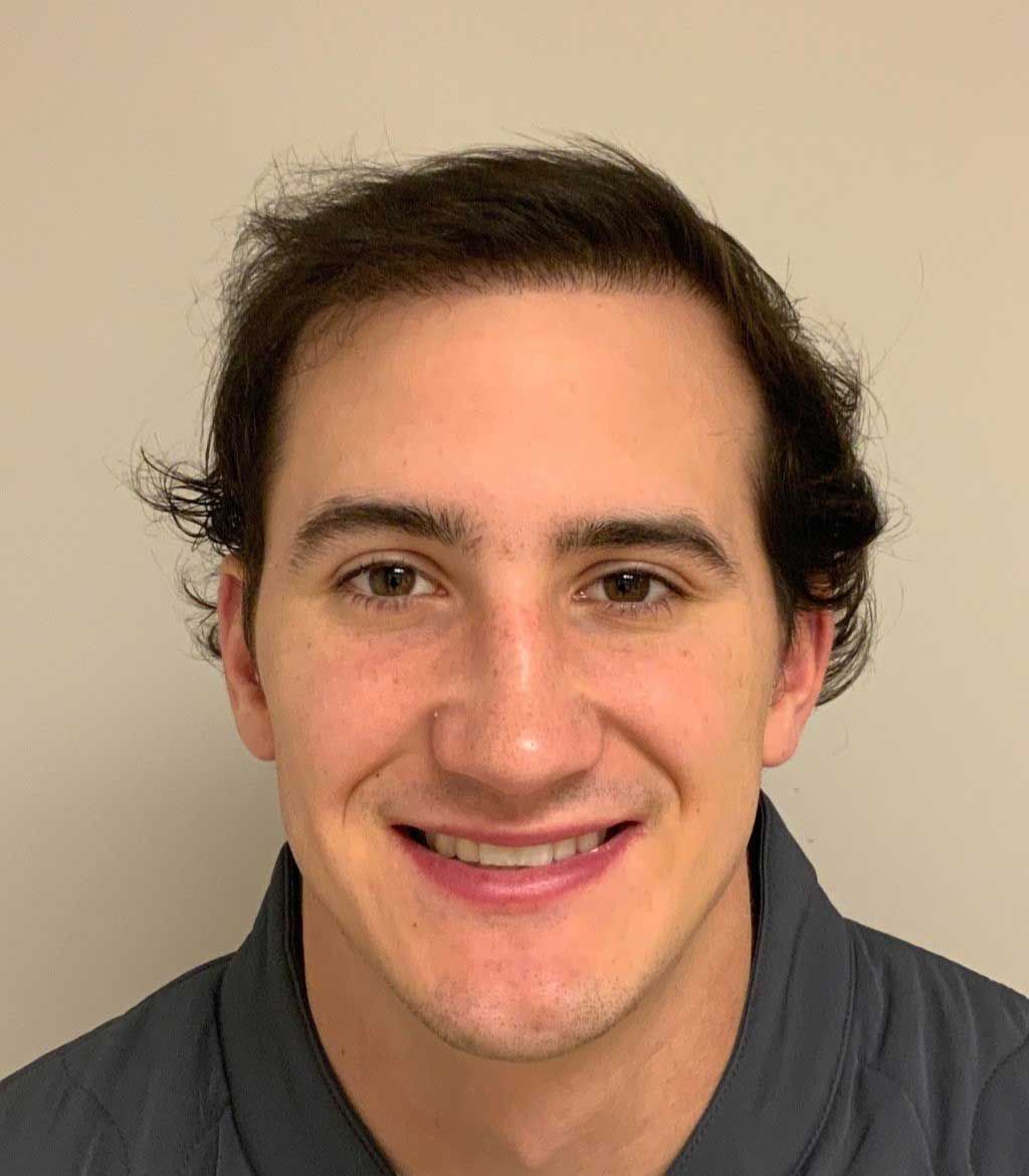 Frontal view of hair restoration - after.