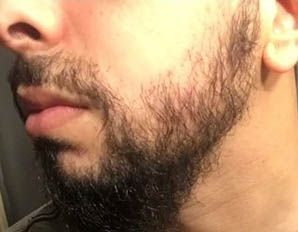 beard growth after