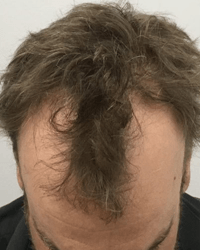 hair thinning