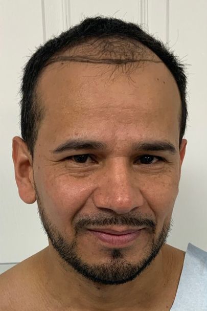 Regency Hair Restoration work