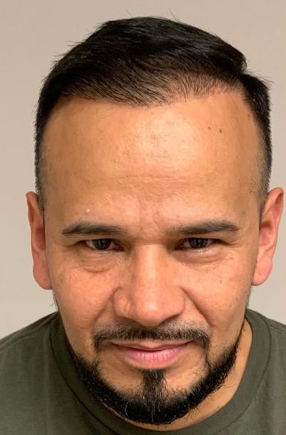 Regency Hair Restoration work