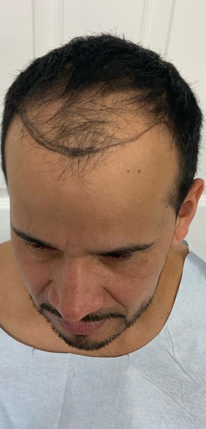 Regency Hair Restoration work