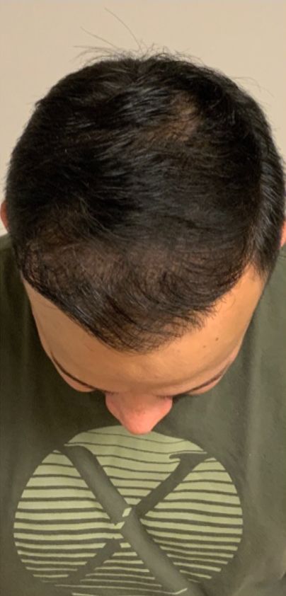 Regency Hair Restoration work