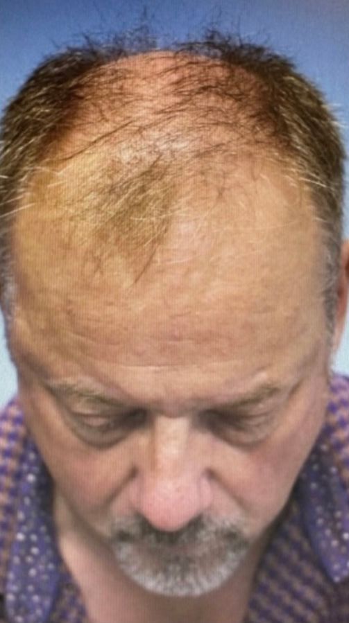 Regency Hair Restoration work