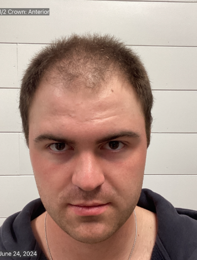 A man with a bald head is looking at the camera.