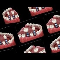 Several models of dental implants in an open mouth, showing the placement of implants and the final tooth.