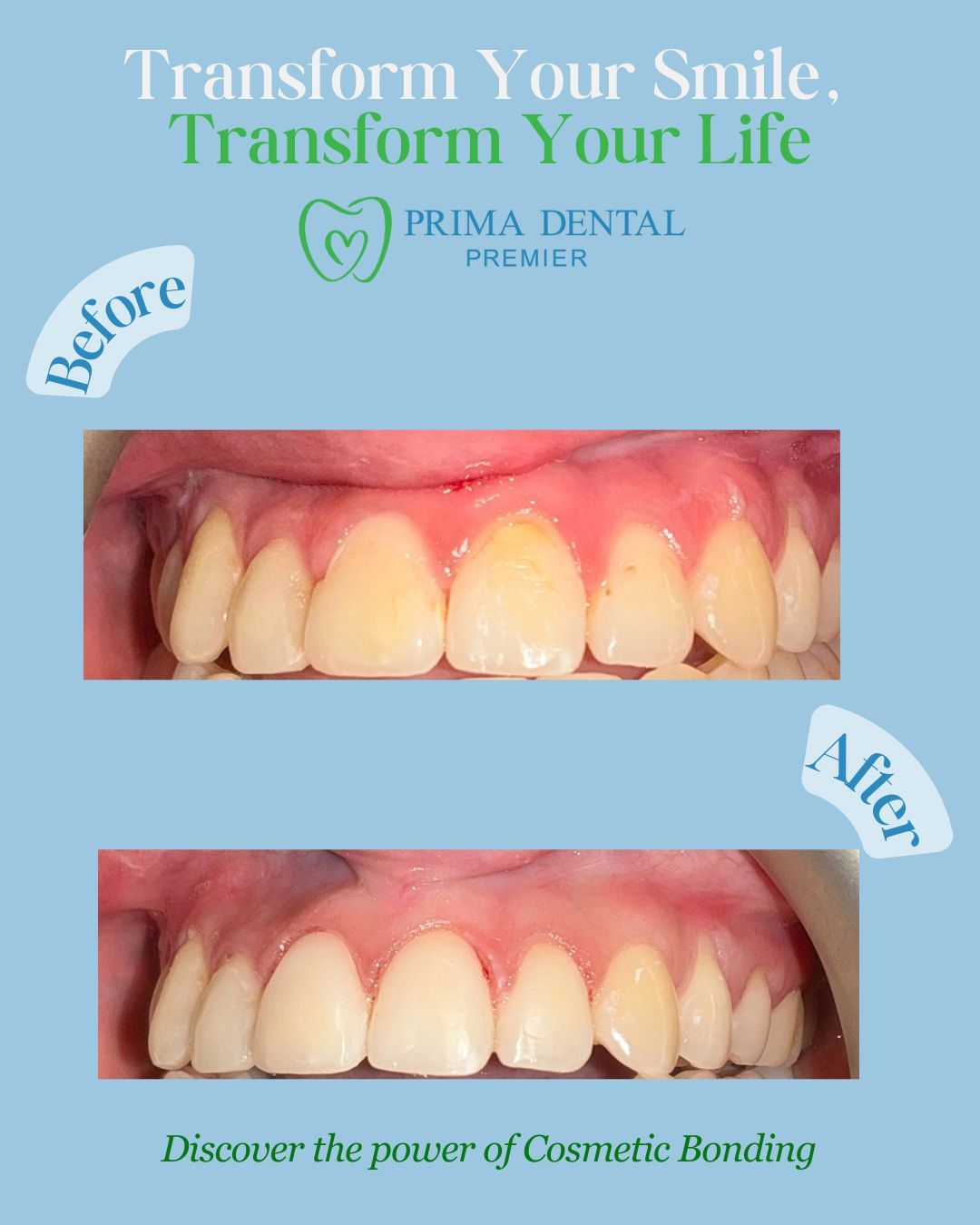 Before and after photos showing teeth transformation with cosmetic bonding, light blue background.
