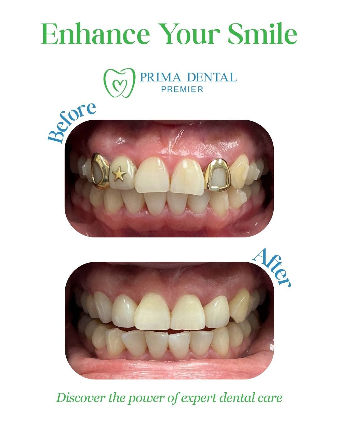 Dental before-and-after of a smile. Before shows gold caps, after shows white teeth.