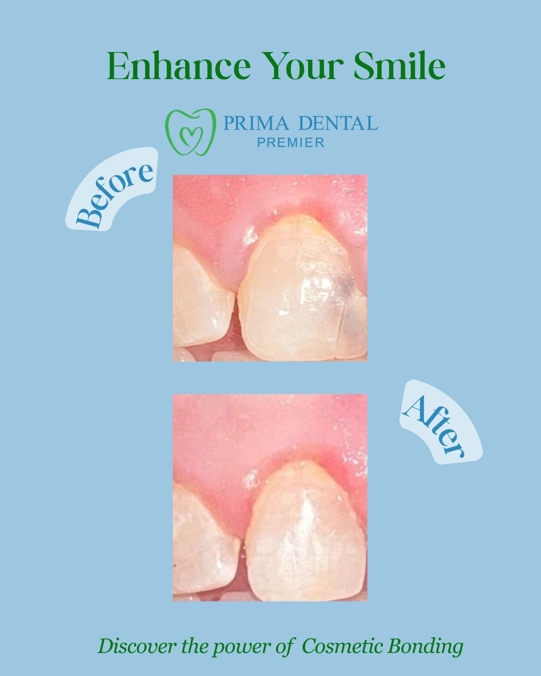 Dental advertisement. Shows before & after cosmetic bonding. Top shows tooth with discoloration. Bottom shows the corrected tooth.