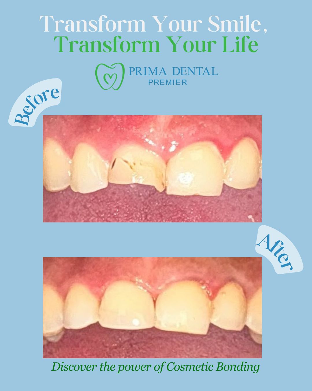 Before-and-after of cosmetic bonding. Top: chipped tooth. Bottom: repaired tooth. Blue background with text and logo.