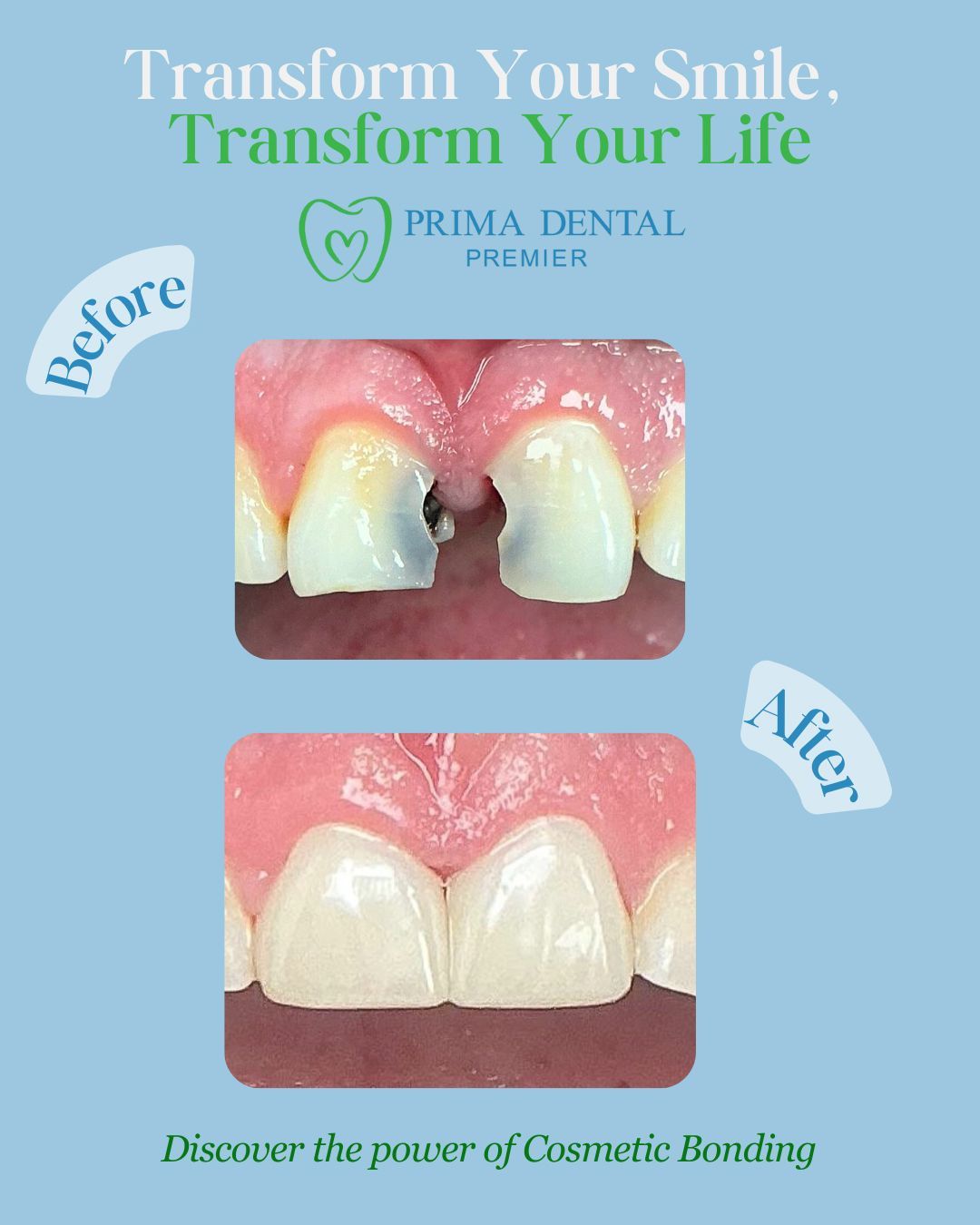 Cosmetic bonding before and after: damaged teeth are repaired, resulting in a perfect smile.