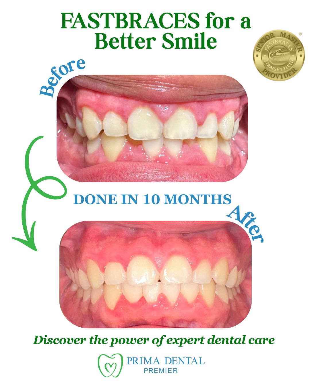 Before-and-after of teeth straightened with Fastbraces in 10 months. Top: crooked teeth. Bottom: aligned teeth.