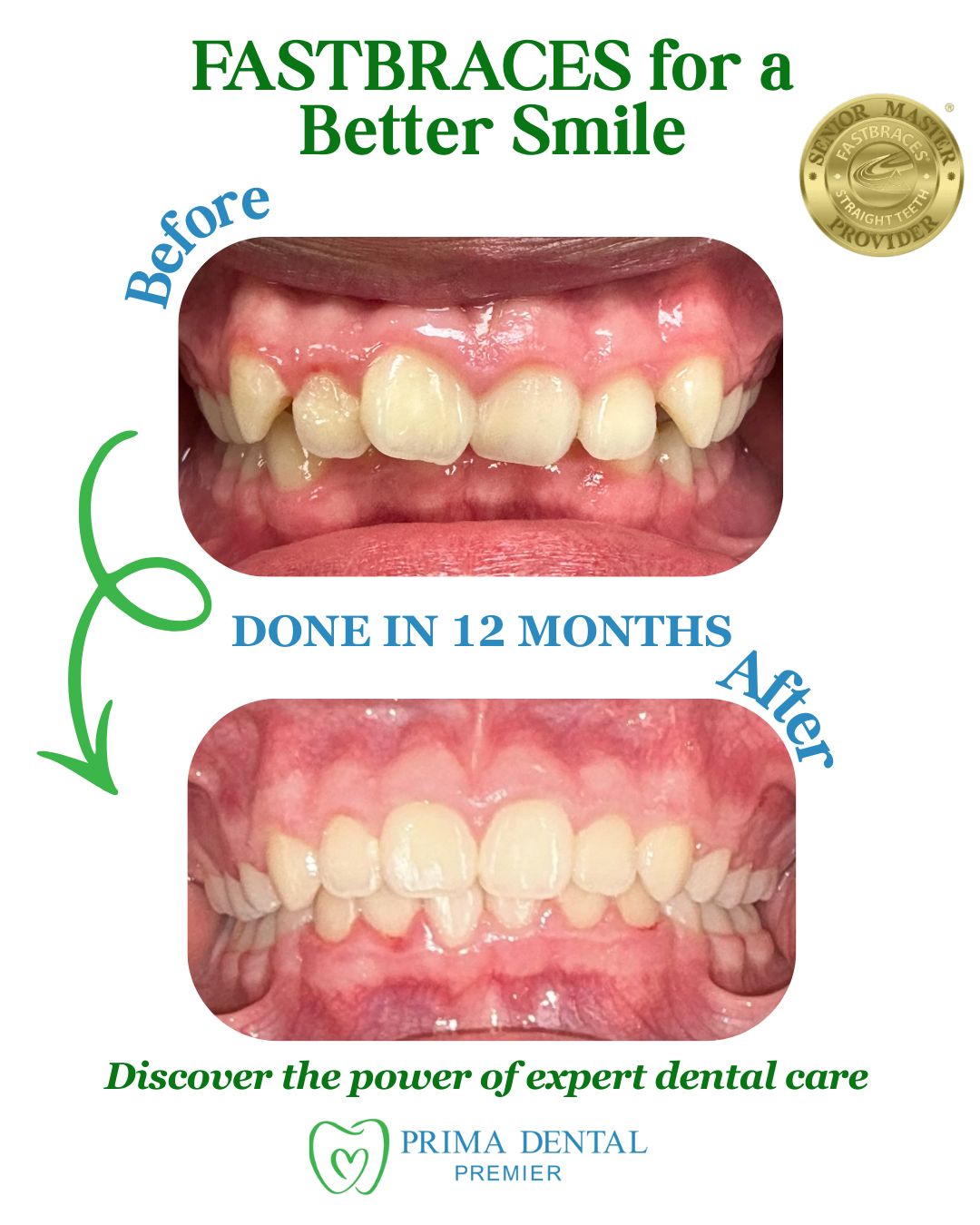 Side-by-side comparison: Crooked teeth before, straighter teeth after 12 months with Fastbraces.