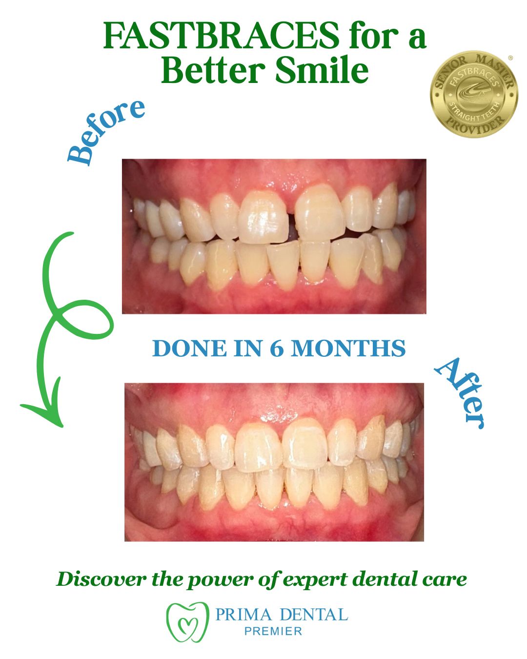 Comparison of teeth before and after Fastbraces treatment, showing straighter teeth.