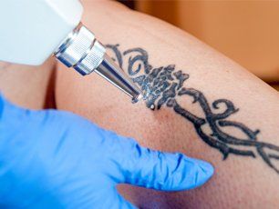 Tattoo removal services