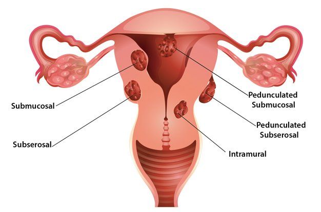 semaglutide and uterine fibroids Oklahoma City, OK Uterine Fibroids: Hiding in Plain