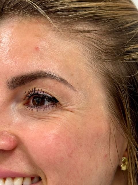Close-up of a person's eye and face with visible wrinkles around the eye.
