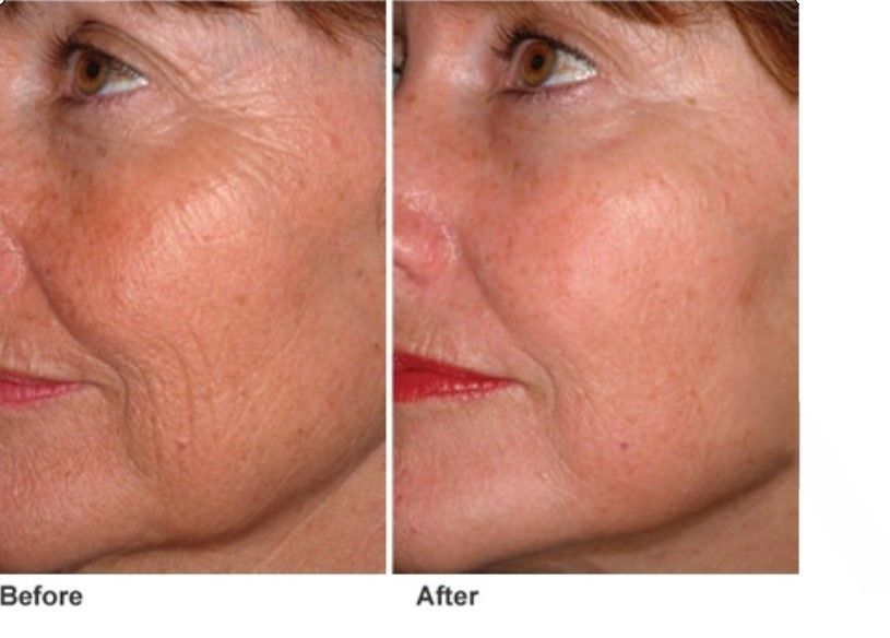 before and after laser treatment