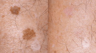 brown spot