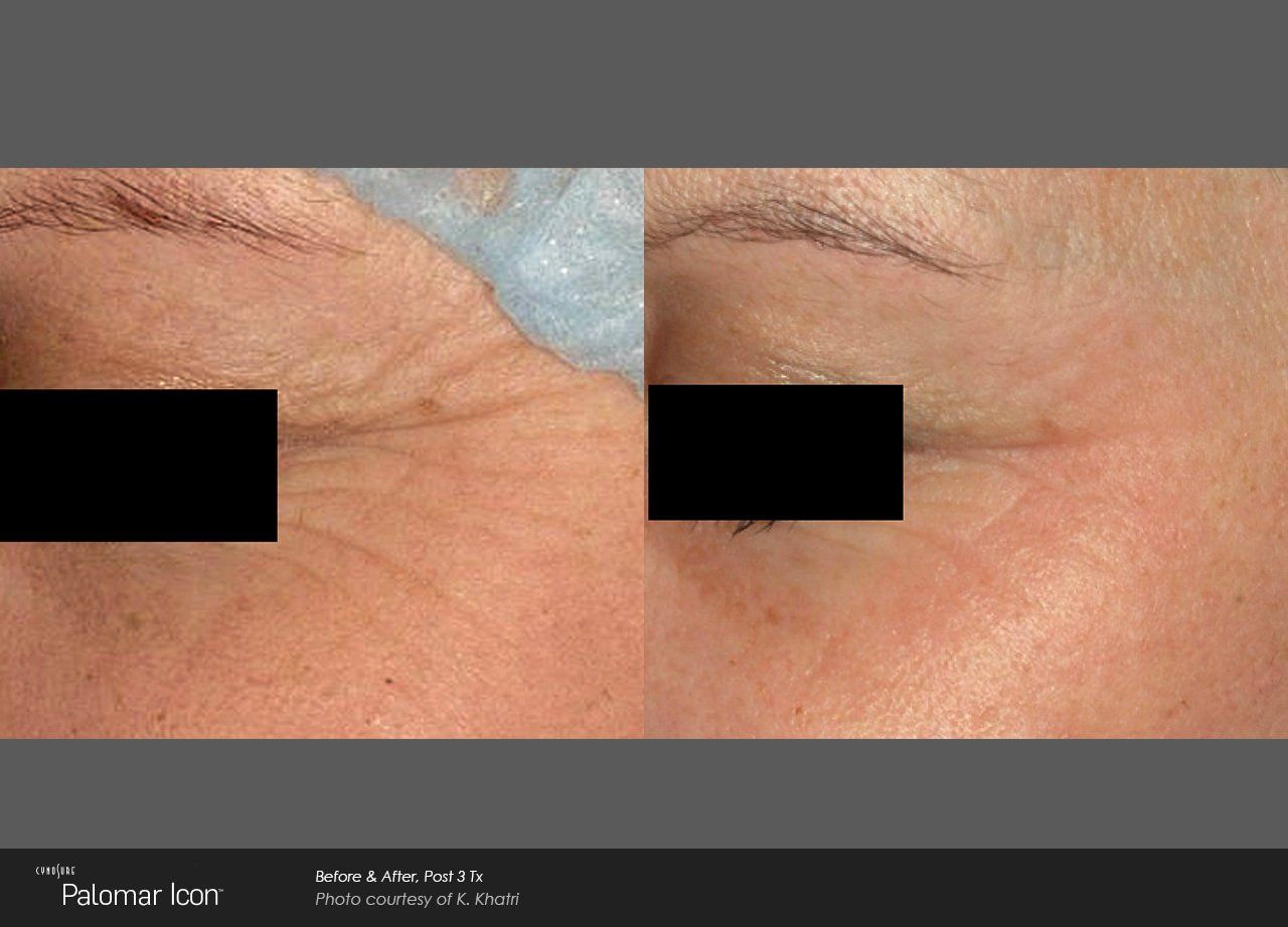 Skin revitalization