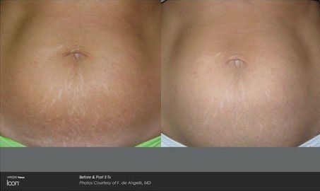 Stretchmarks