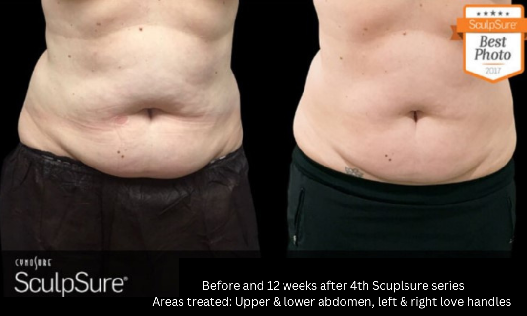 SculpSure laser service