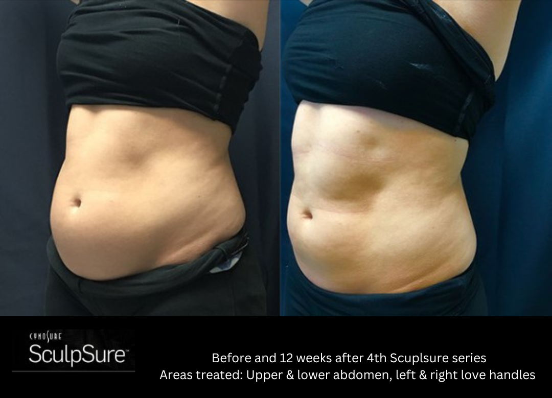 SculpSure laser service