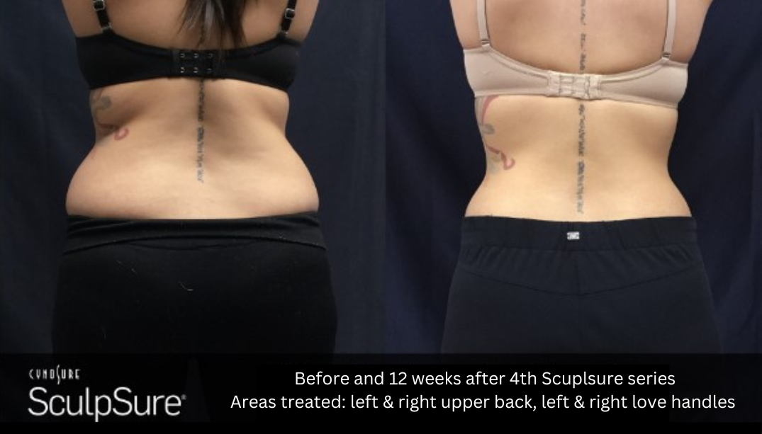 SculpSure laser service