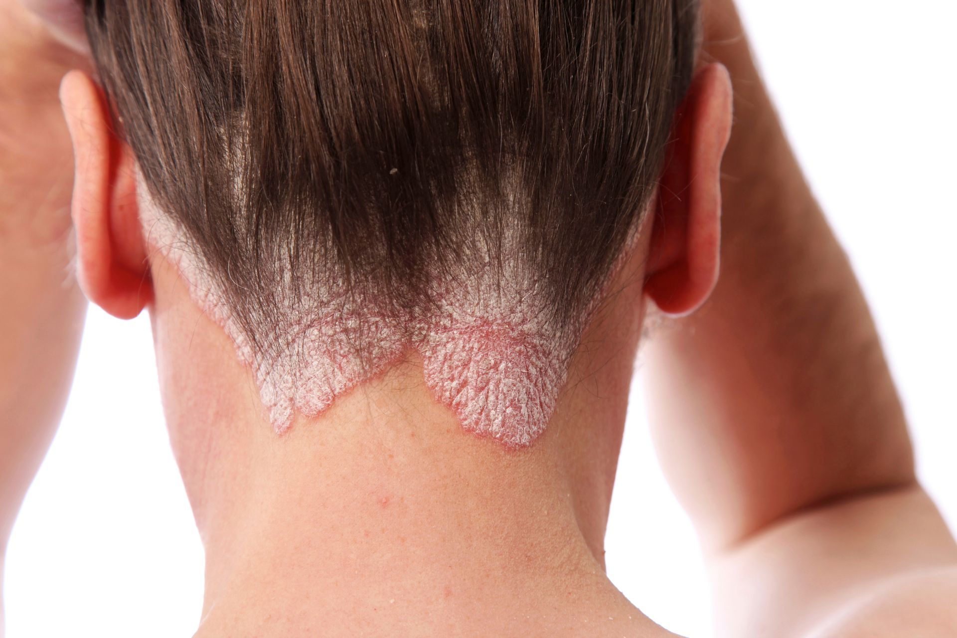 eczema treatment