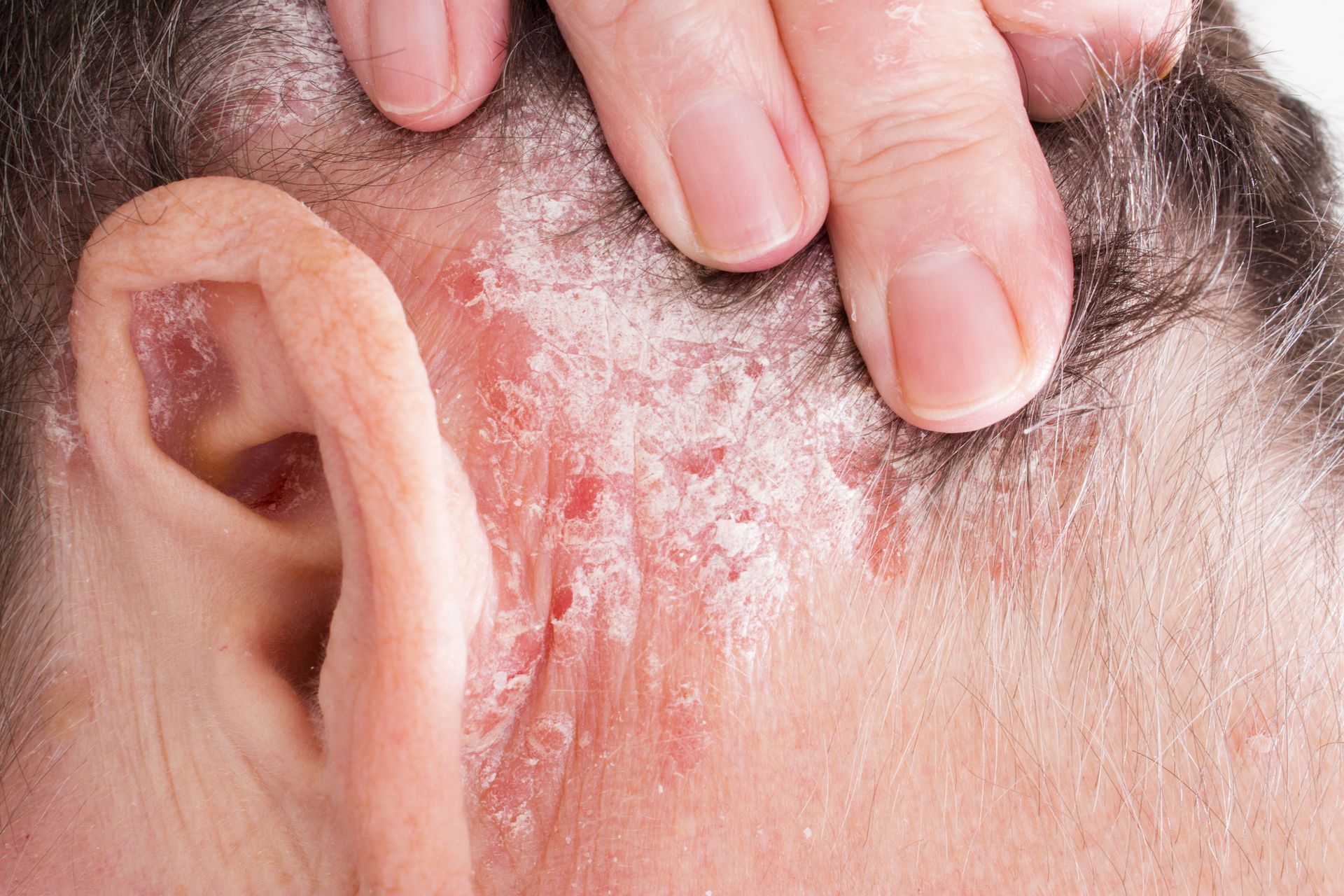 eczema