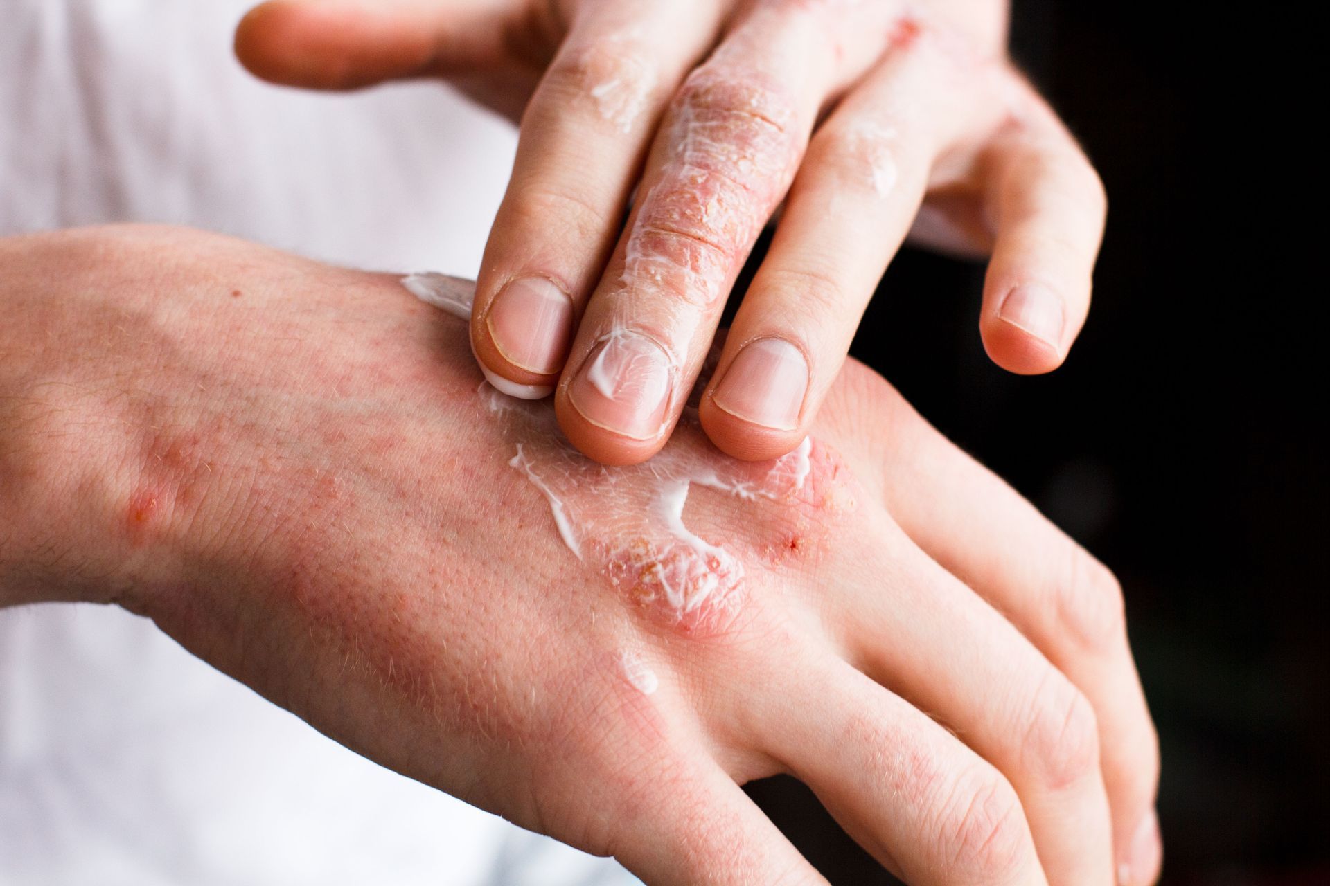 eczema treatments