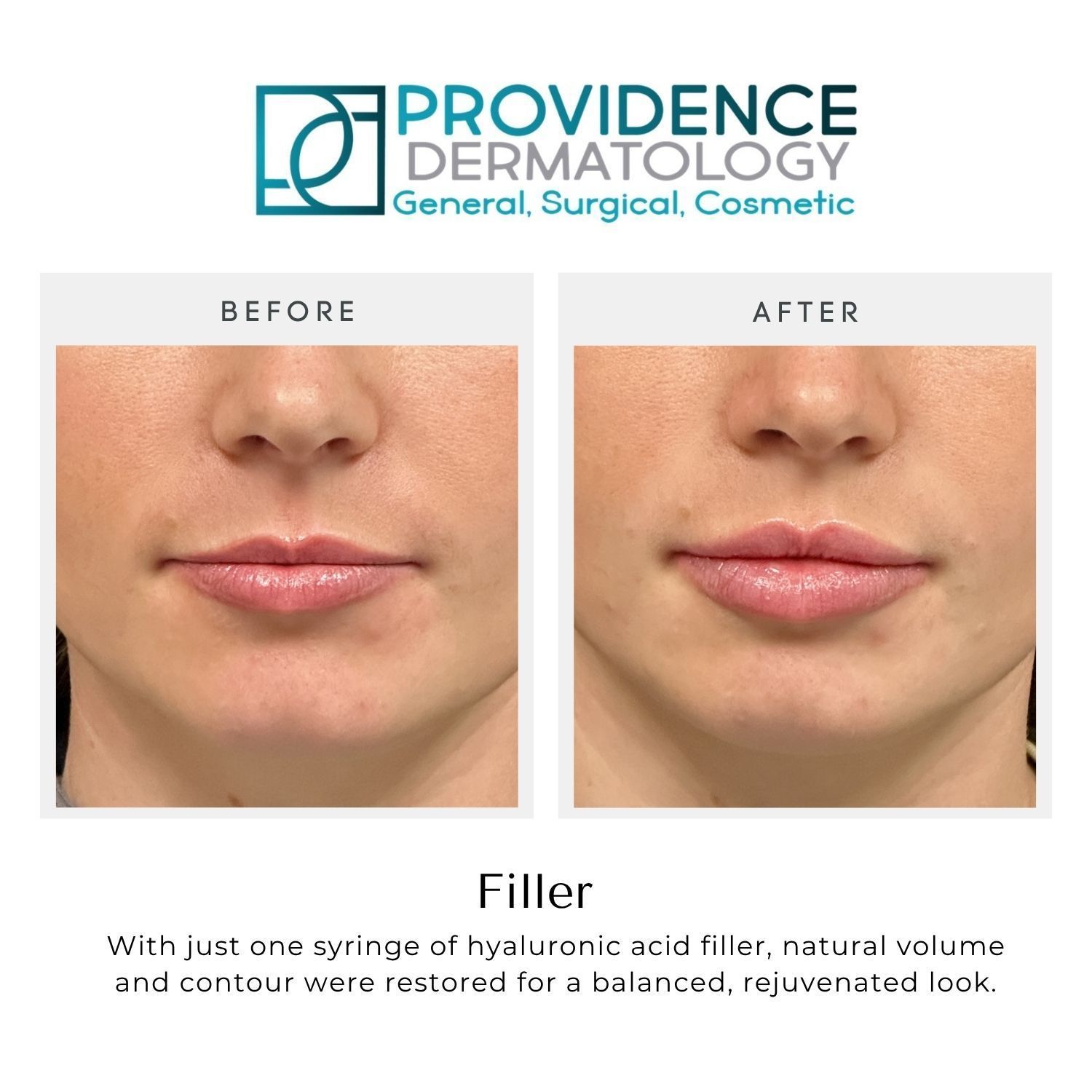 Before-and-after lip filler ad from Providence Dermatology showing fuller lips and smoother contours
