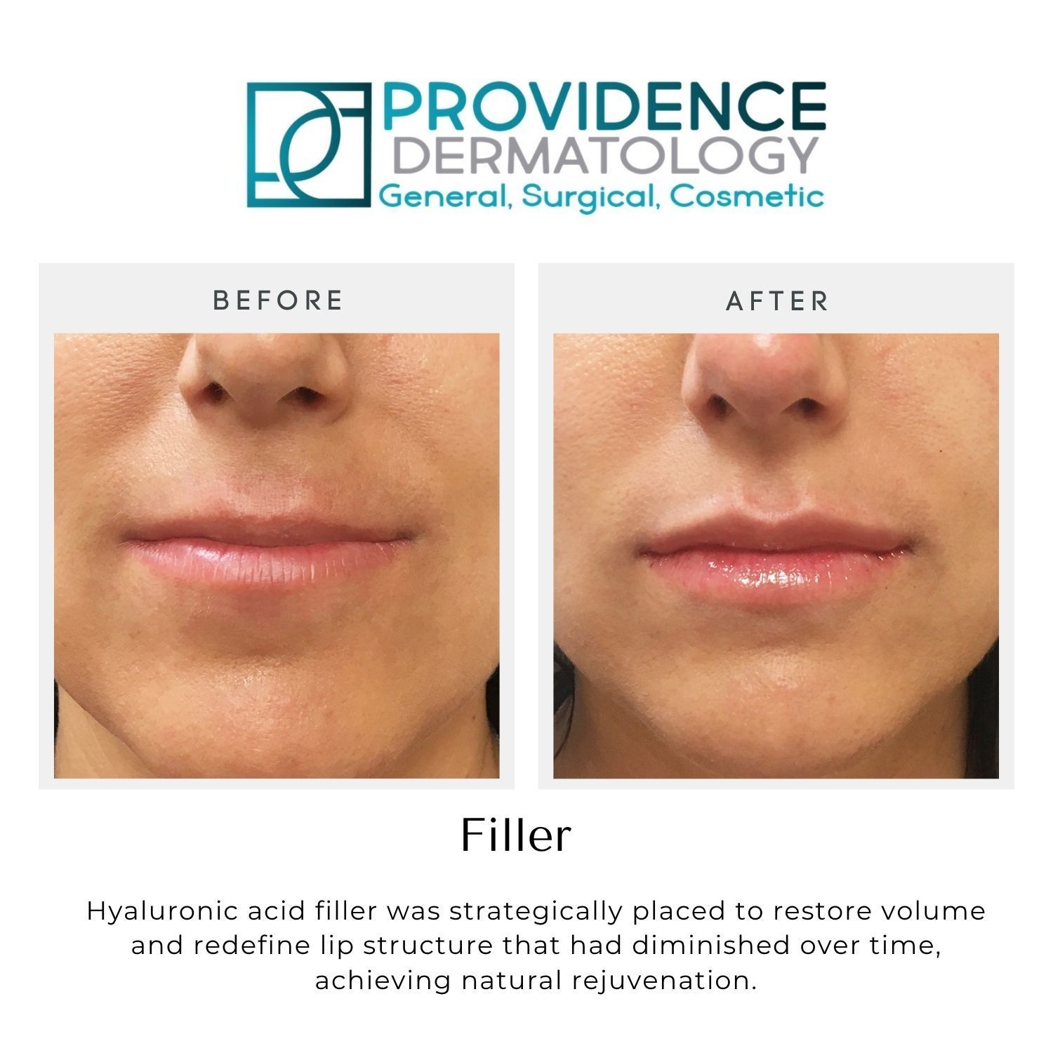 Providence Dermatology filler ad showing before-and-after close-ups of lips and lower face
