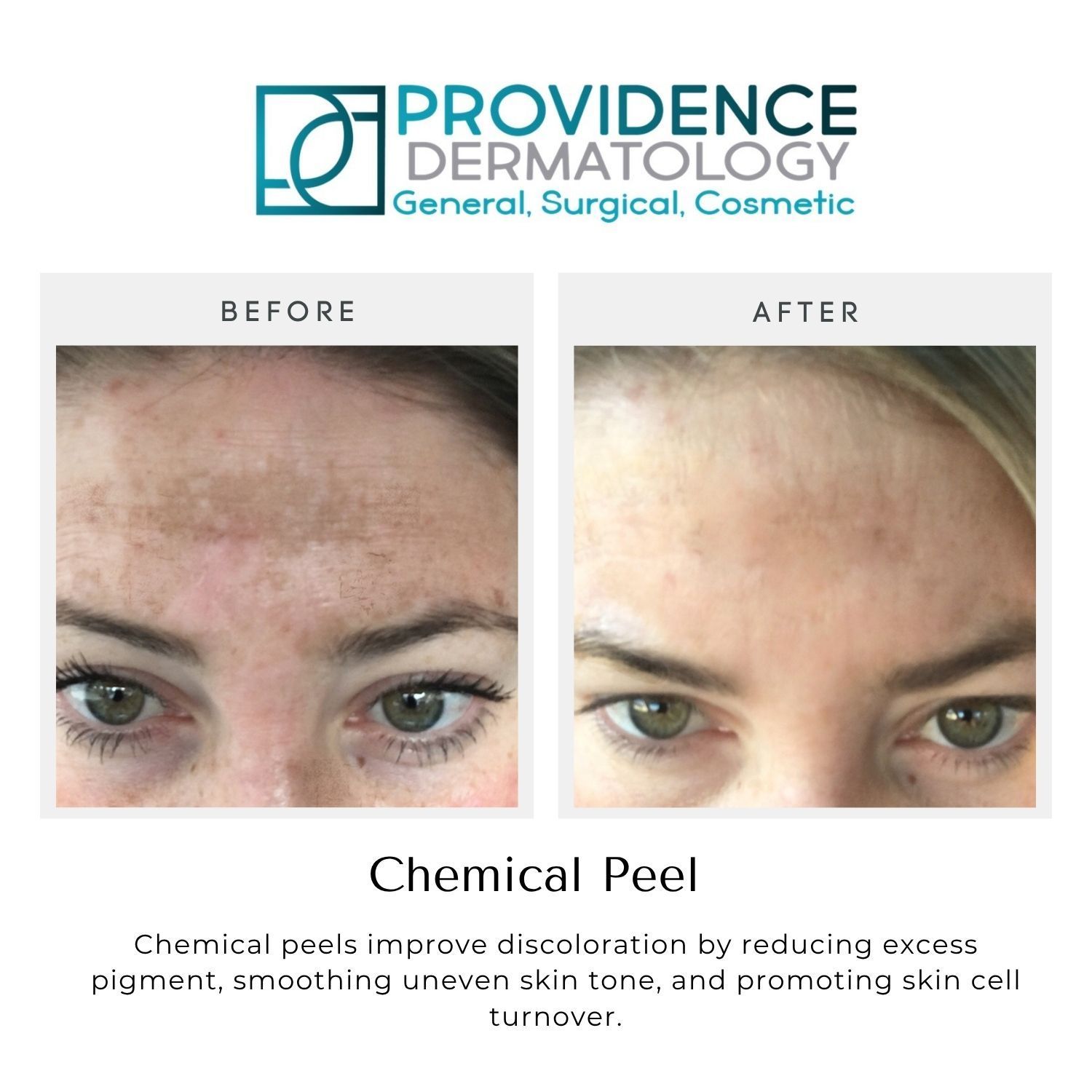 Before-and-after close-up of a face showing improved skin tone after a chemical peel