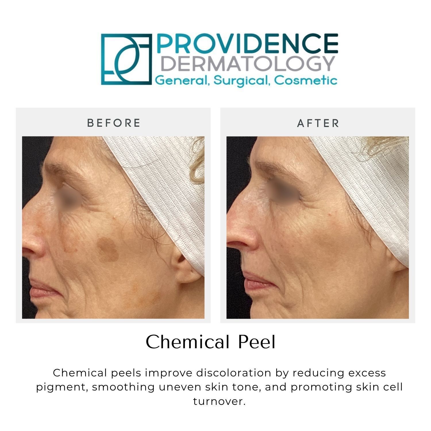 Before-and-after close-up of facial skin after a chemical peel, showing reduced dark spots and smoother texture.