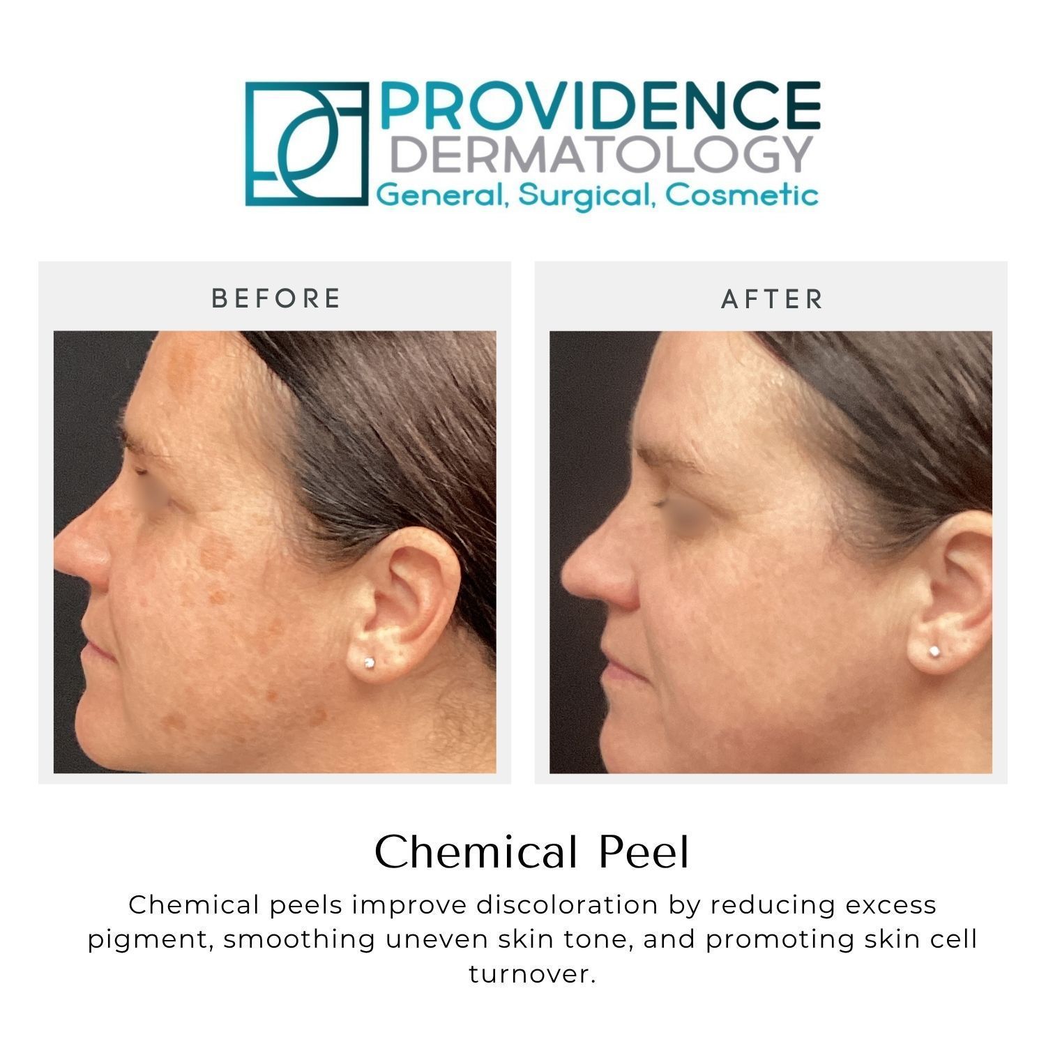 Providence Dermatology before-and-after cheek photos showing clearer skin after a chemical peel