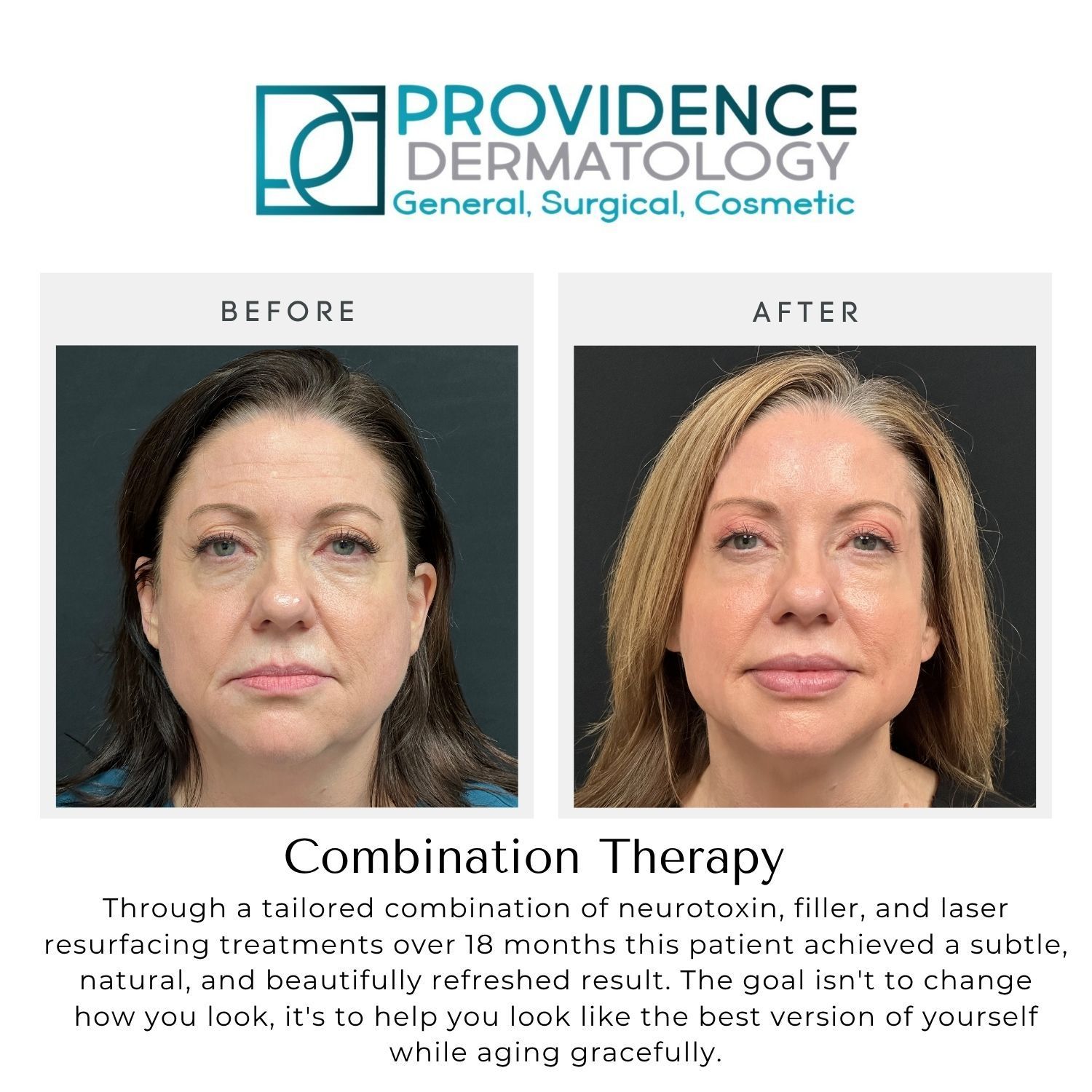 Before-and-after photo of a woman’s face for Providence Dermatology combination therapy