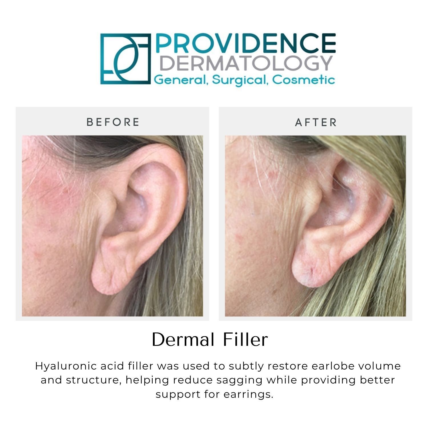 Before-and-after close-up of an ear showing dermal filler results, with clinic logo and text.