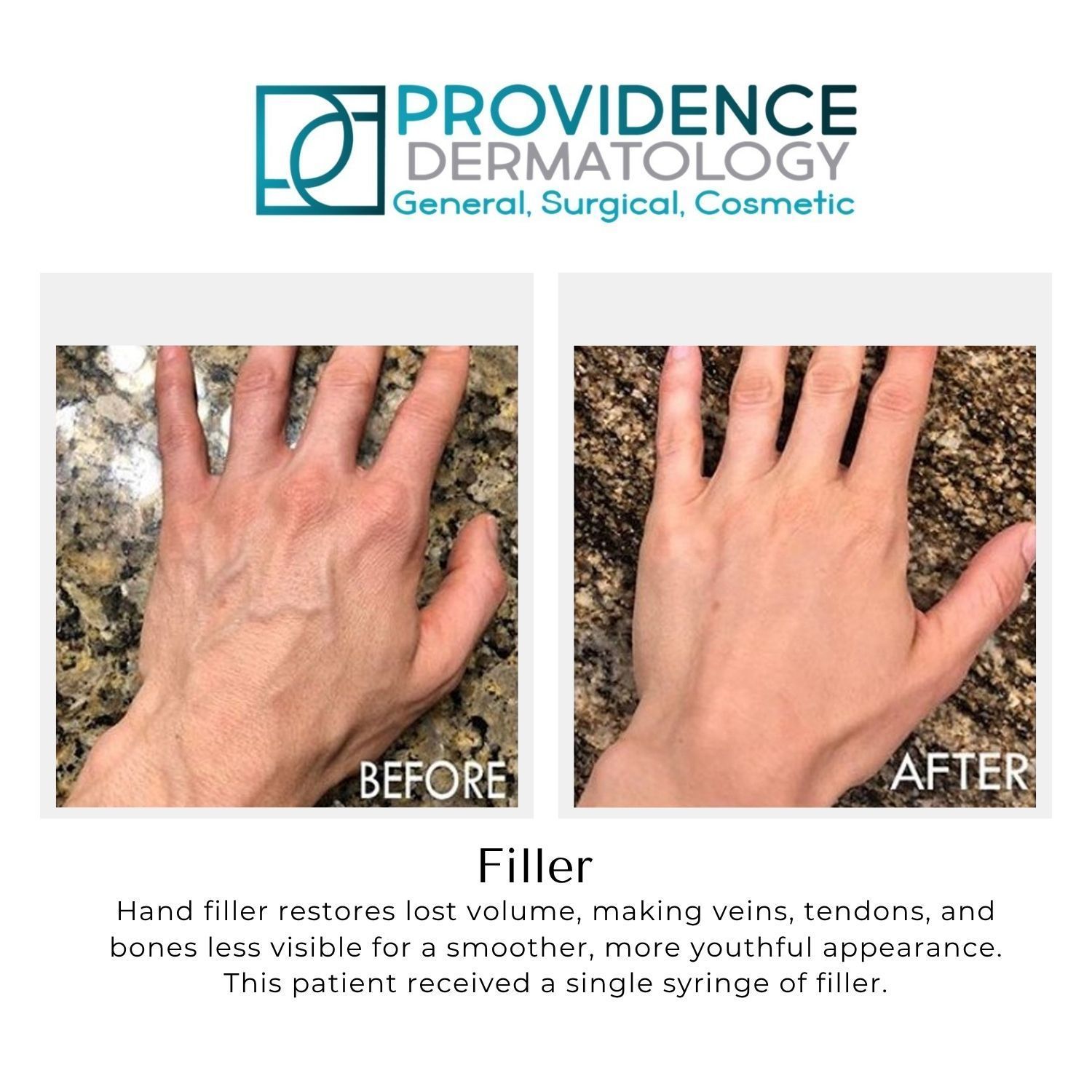 Providence Dermatology hand filler before-and-after showing fuller, smoother hand appearance