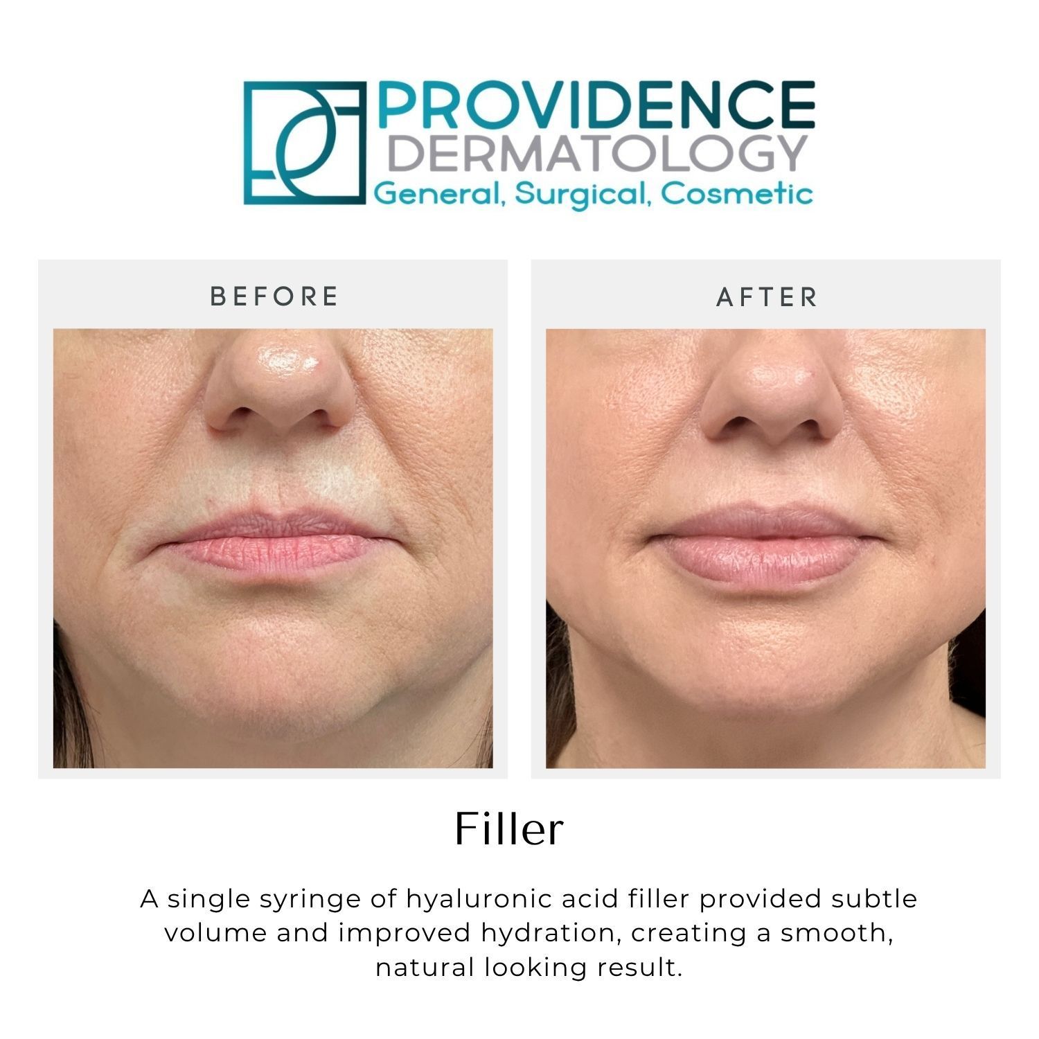Before-and-after lower face photos showing smoother, fuller lips after filler treatment
