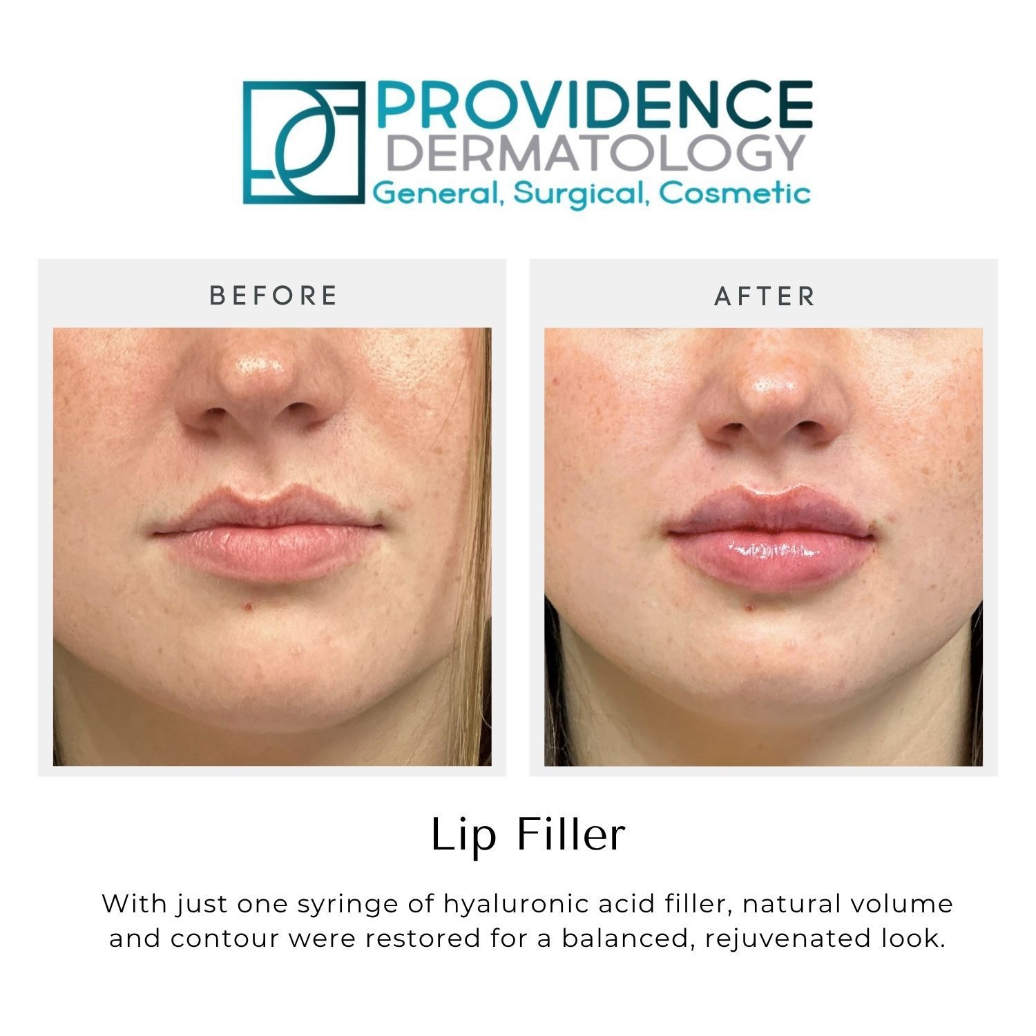 Before-and-after lip filler comparison showing fuller, glossier lips after treatment