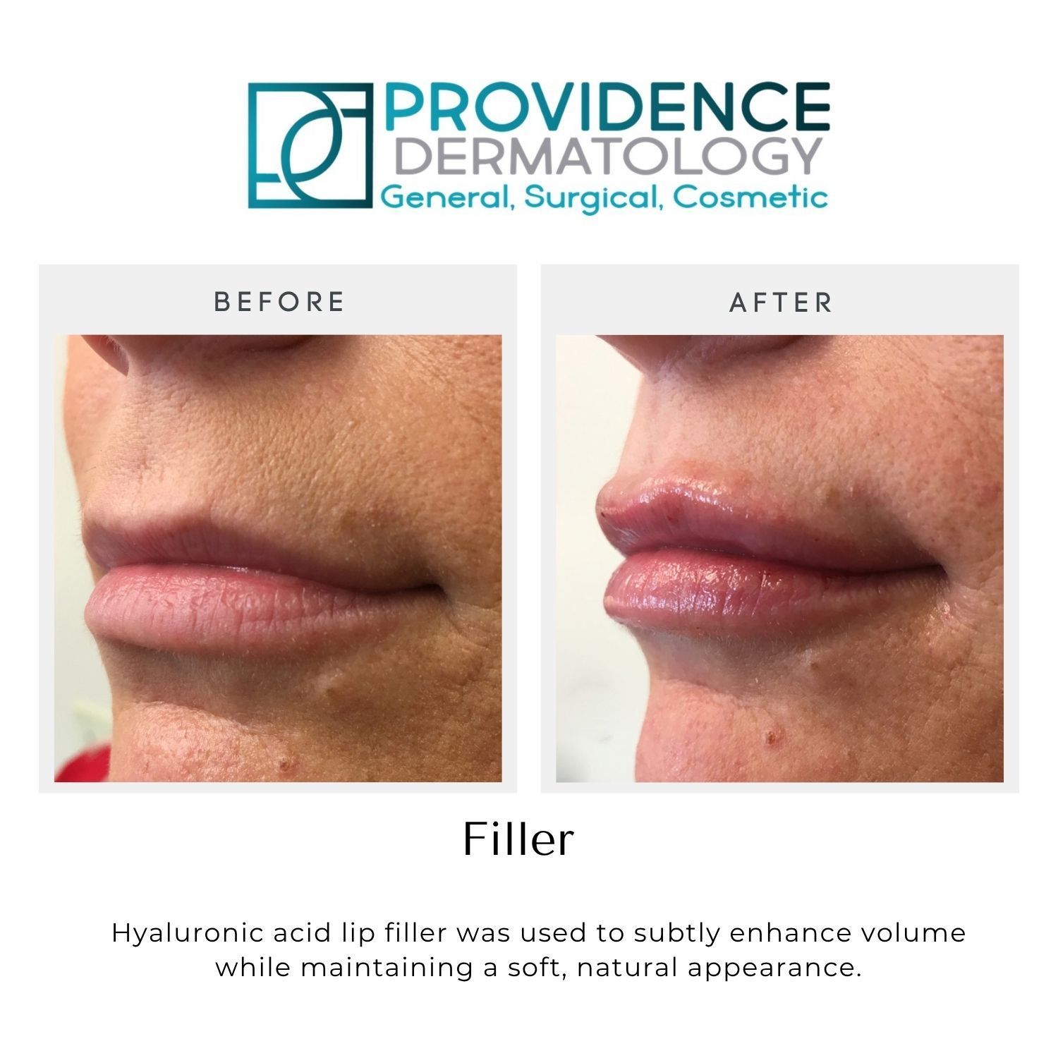 Before-and-after close-up of lips showing fuller volume after dermal filler treatment.