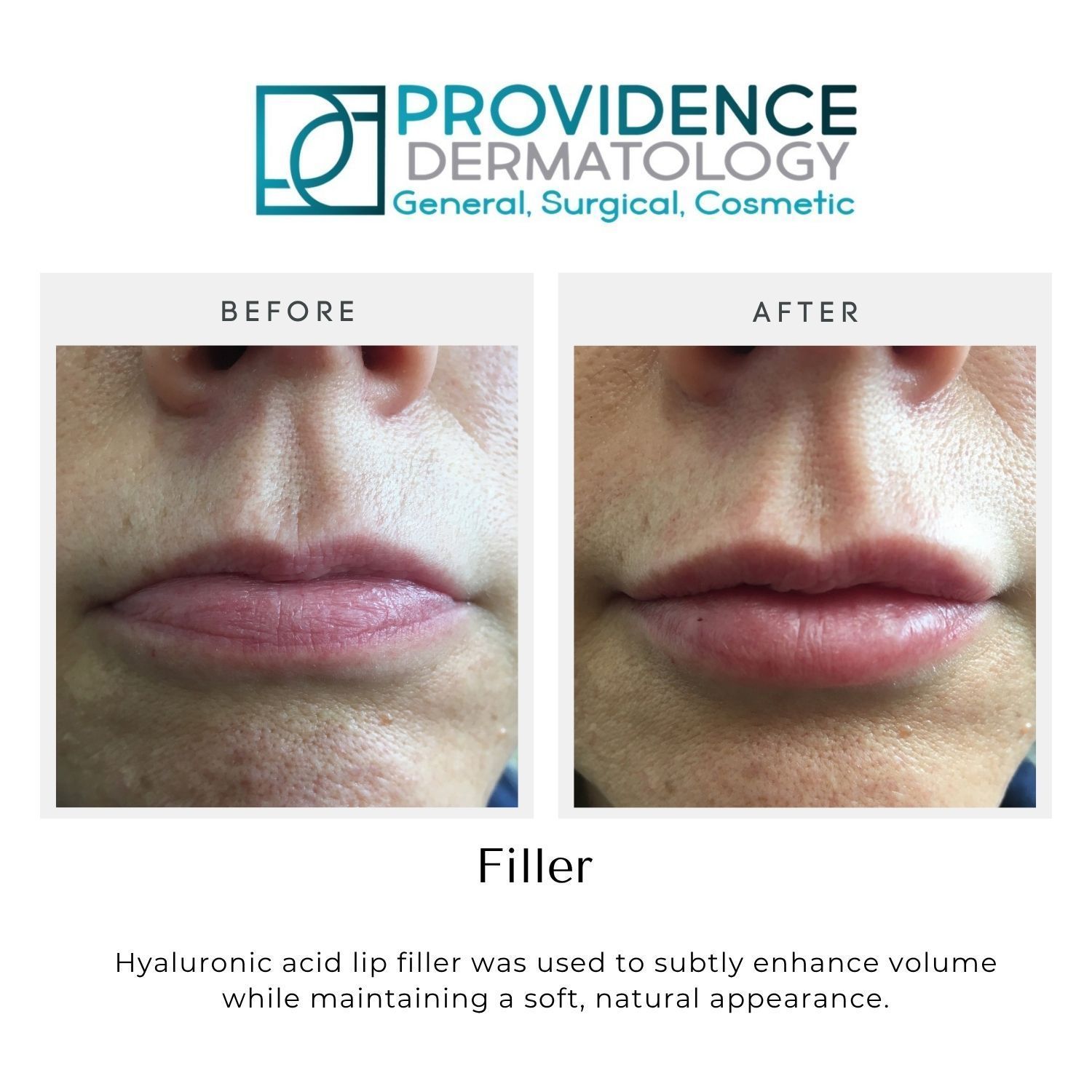 Before-and-after close-up of lips after hyaluronic acid filler treatment, shown by Providence Dermatology.