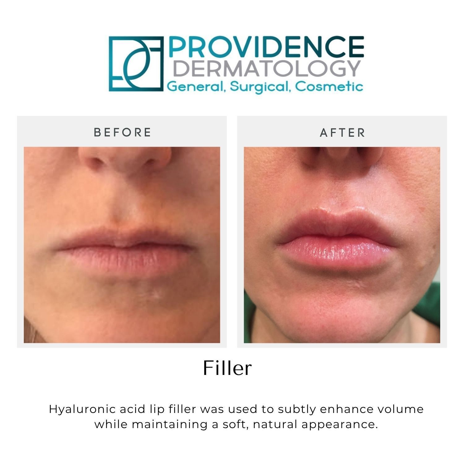 Before-and-after lip filler results from Providence Dermatology, showing fuller lips after treatment